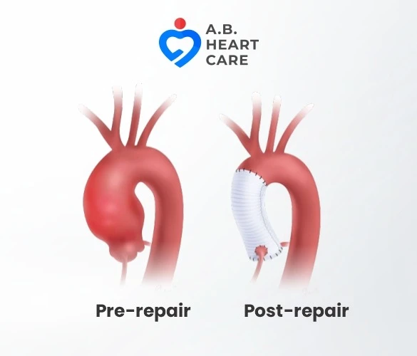 Understanding Bentall Surgery