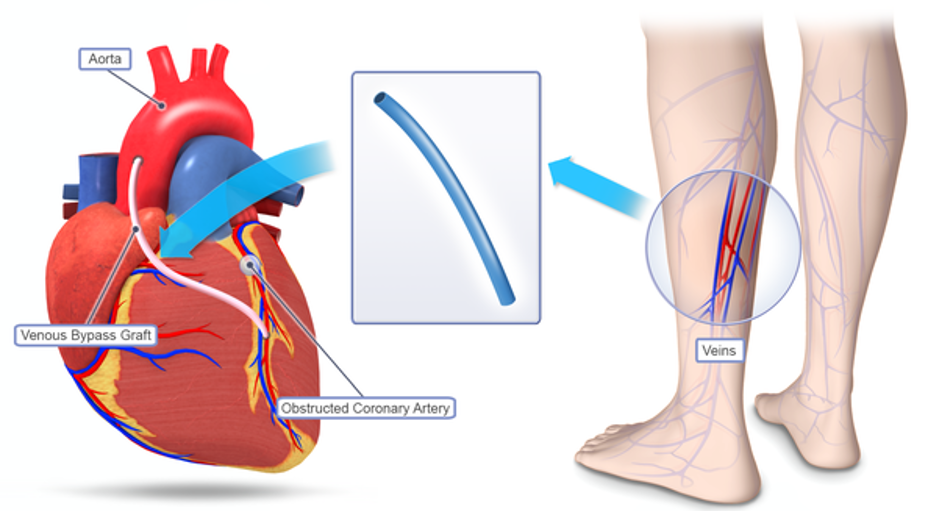 bypass-surgery-in-ghaziabad