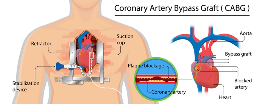 coronary-artery-bypass-graft