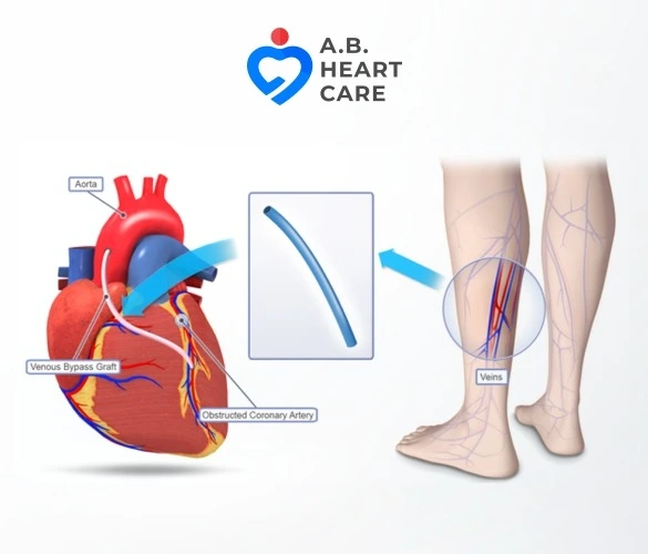 Bypass and Open-Heart Surgery