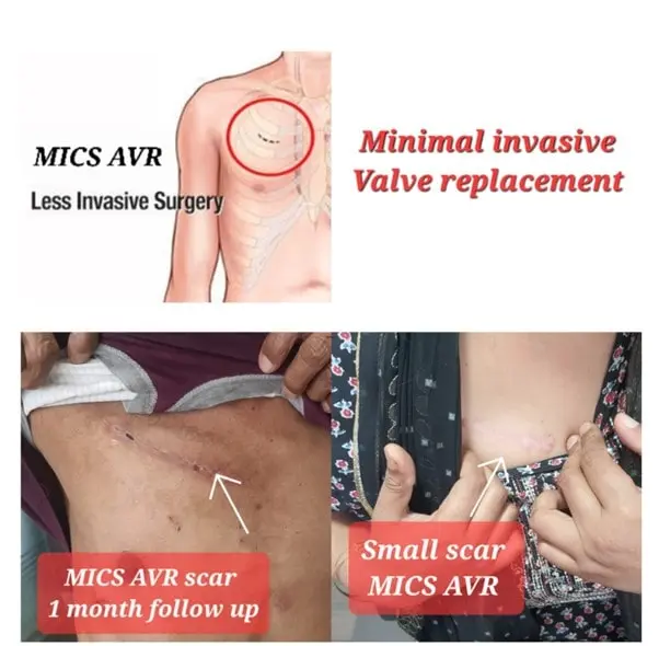 Minimally Invasive Heart Surgery Chandigarh